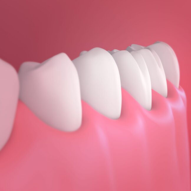 Periodontal Surgery
