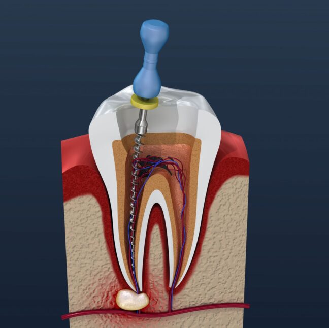 Root Canal Therapy