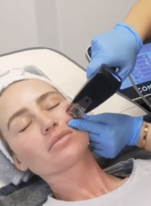 Morpheus8 Treatment in Glasgow